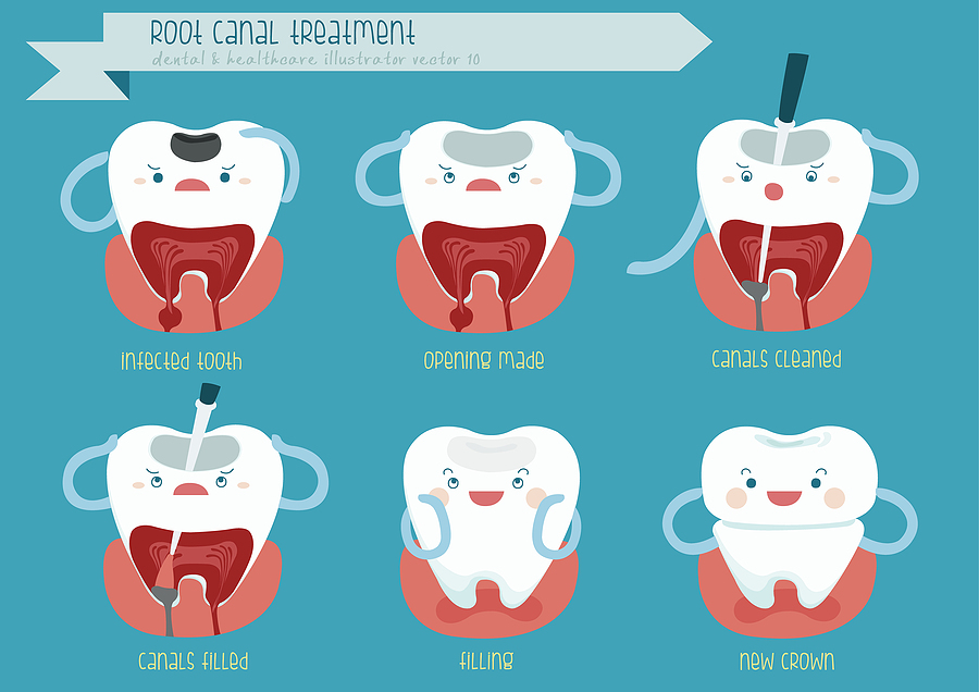 Expert Care for Root Canals in Albuquerque, NM: What You Need to Know