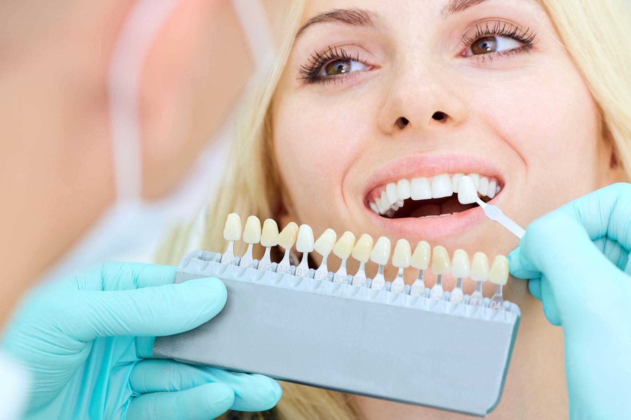 Dental Veneers: How To Improve Your Smile
