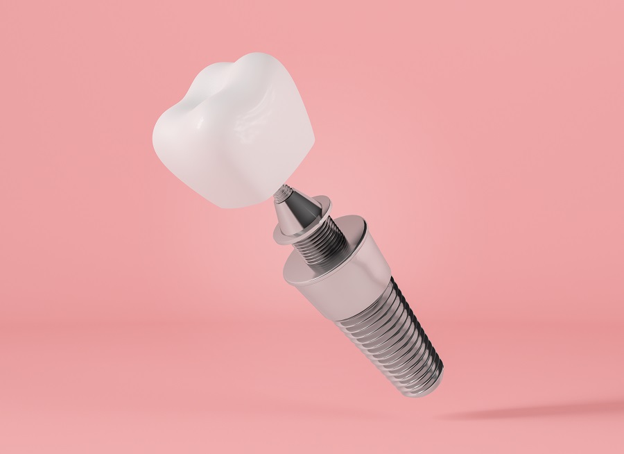 Will I Need A Bone Graft For Dental Implants