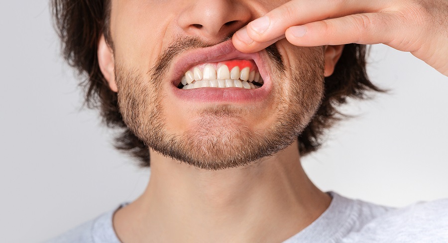 Why Are My Gums Bleeding