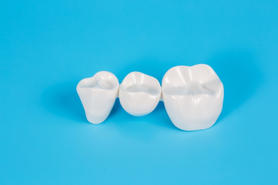 Are Dental Bridges Effective for Replacing Missing Teeth?