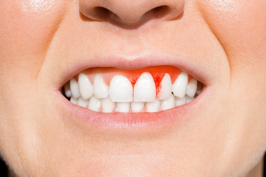 Is Gum Disease Preventable?