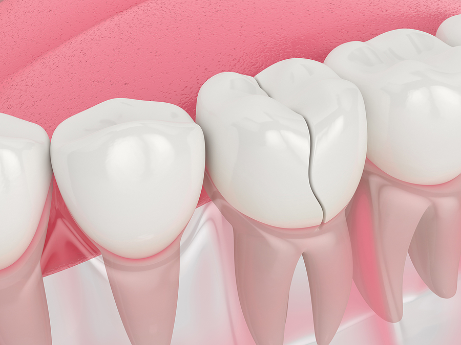 What to Do If You Have a Broken, Chipped, or Fractured Tooth in Albuquerque, NM