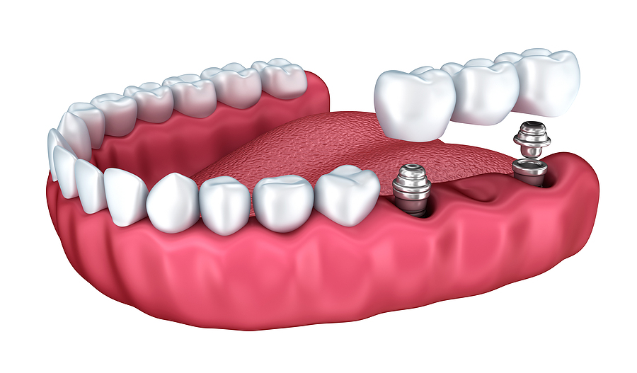 Dental Implants: A Comprehensive Guide to Restoring Your Smile in Albuquerque, NM