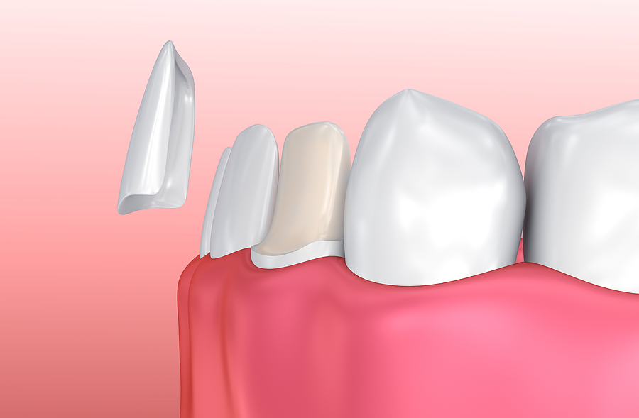 Transform Your Smile with Dental Veneers in Albuquerque, NM